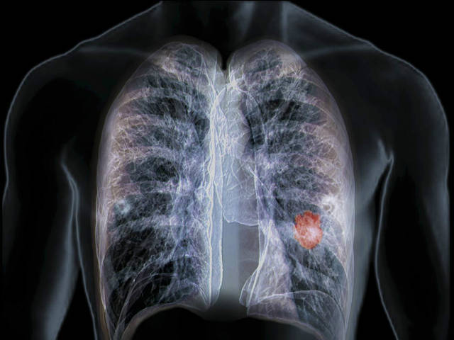 肺癌 末期